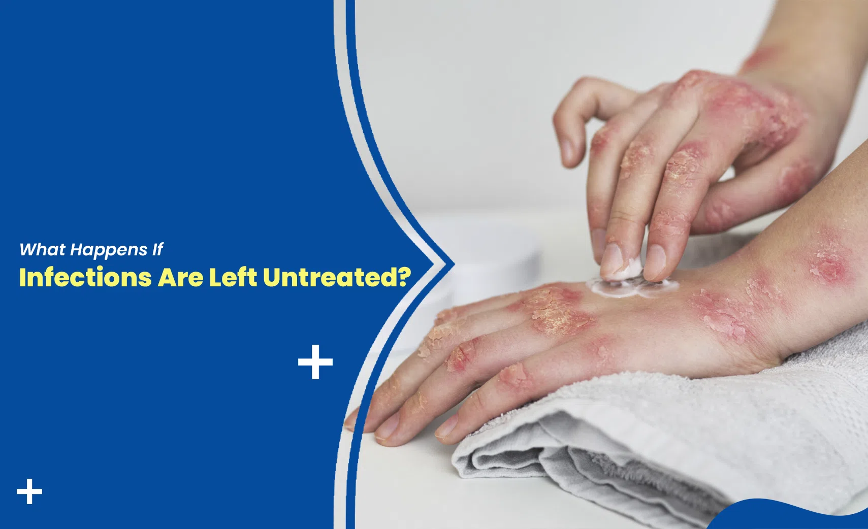 Applying cream on infected skin