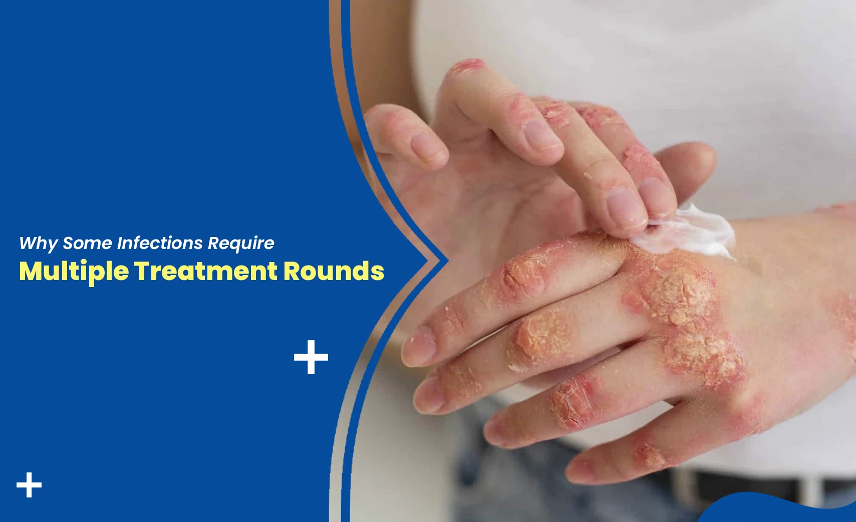 Multiple treatment rounds for infections shown by recurring skin rash needing repeated therapy