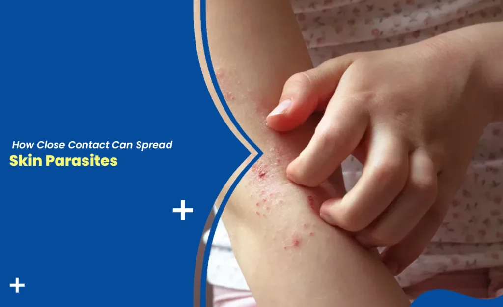 Skin parasites causing itching